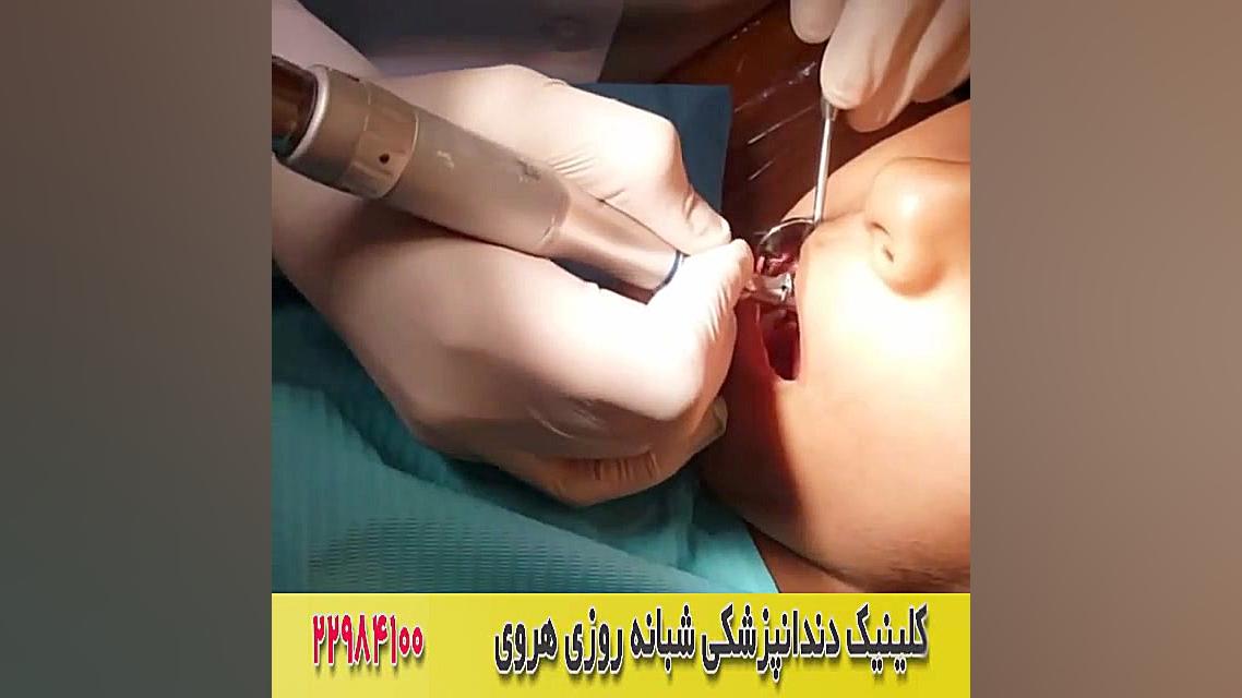 نحوه عصب کشی دندان در دندانپزشکی ANCA