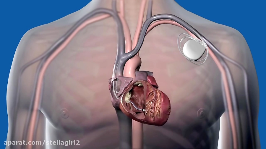 What Is a Defibrillator How Does It Work