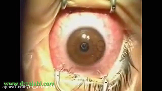 جراحی لیزیک چشم لوسارتان