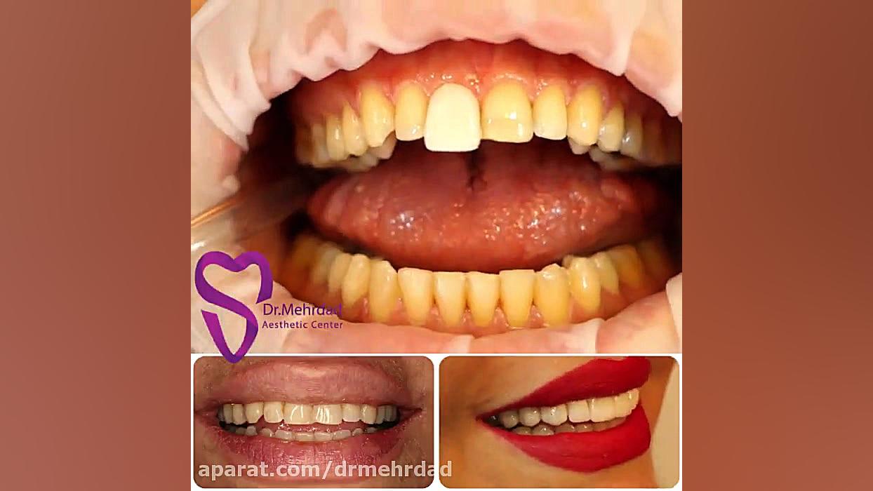 ویدیو اصلاح طرح لبخند با لمینت سرامیکی انسریدا