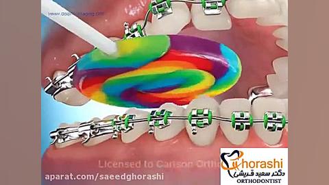 شکستن براکت - دکتر سعید قریشی دکتر سعید قریشی
