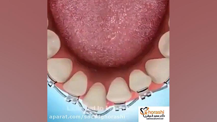 ایجاد فضا برای ارتودنسی - دکتر سعید قریشی دکتر سعید قریشی