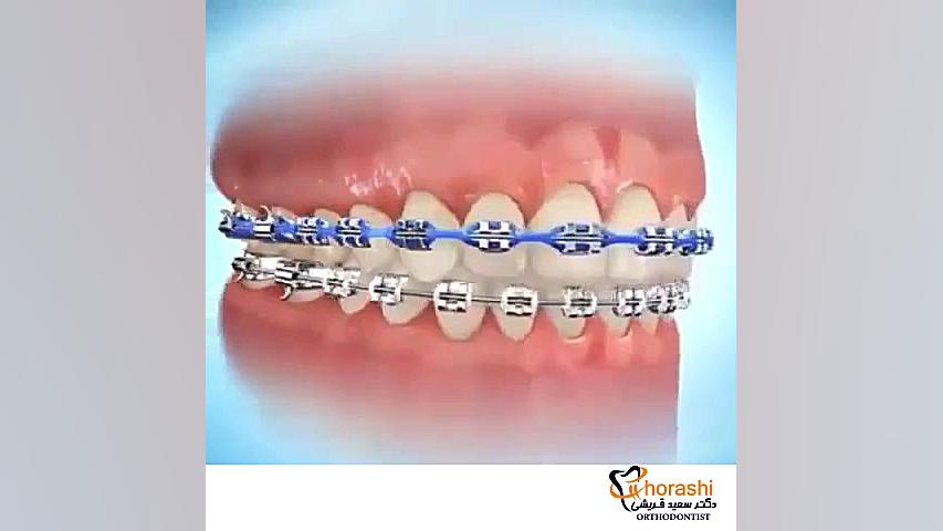 چن الاستیک - دکتر سعید قریشی دکتر سعید قریشی