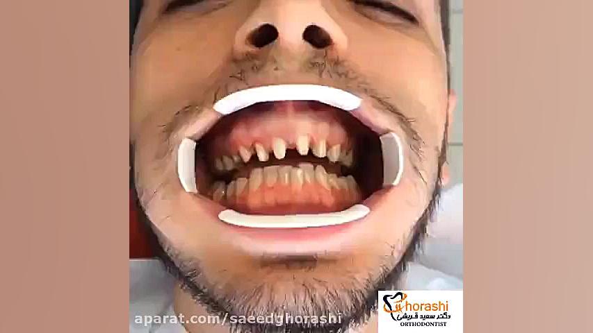 زیبایی دندان - دکتر سعید قریشی دکتر سعید قریشی