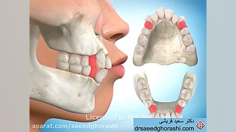 جلو زدگی فک - دکتر سعید قریشی دکتر سعید قریشی