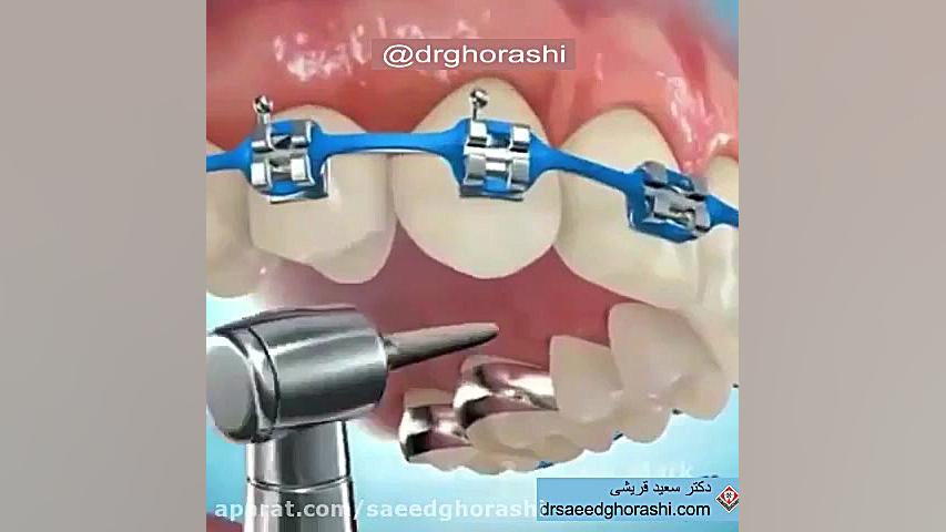 درمان ارتودنسی در صورت نبود دندان پیشین-دکتر قریشی دکتر سعید قریشی