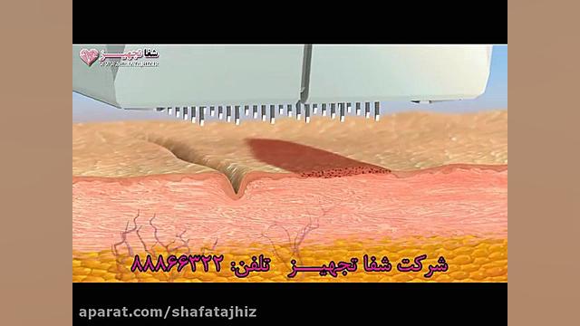 نحوه عملکرد آراف فرکشنال Fractora تست آنتی‌بادی مونوکلونال