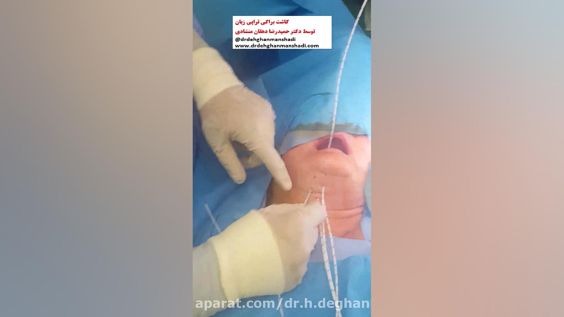 براکی تراپی زبان دکتر حمیدرضا دهقان منشادی
