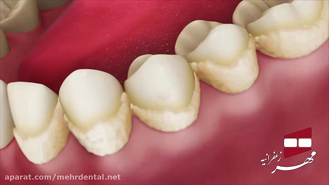 انیمیشن جرمگیری دندان | کلینیک دندانپزشکی مهر زعفرانیه رانولازین