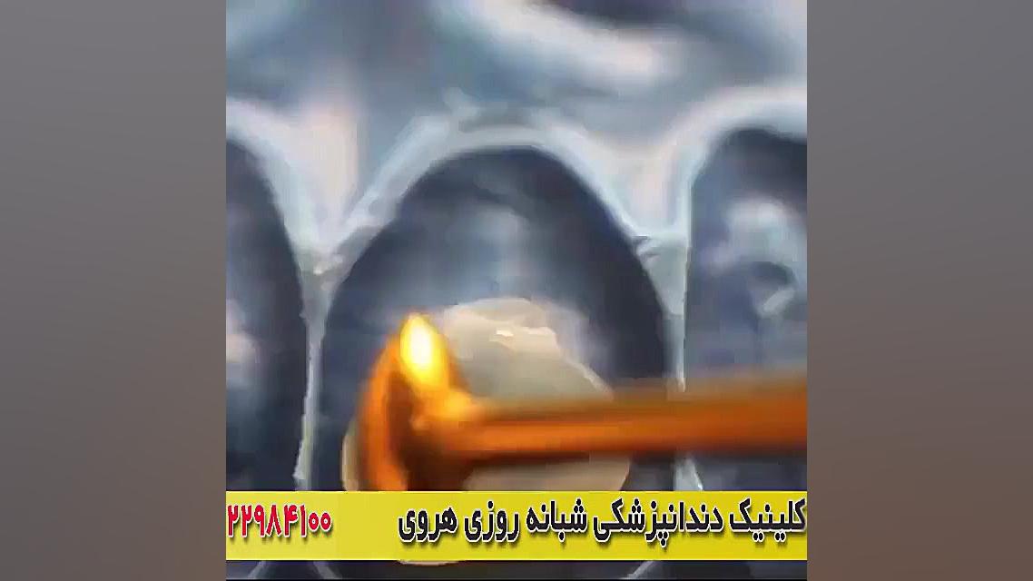 ترمیم دندان شکسته جلو توسط متخصص دندانپزشکی ایلوبامید