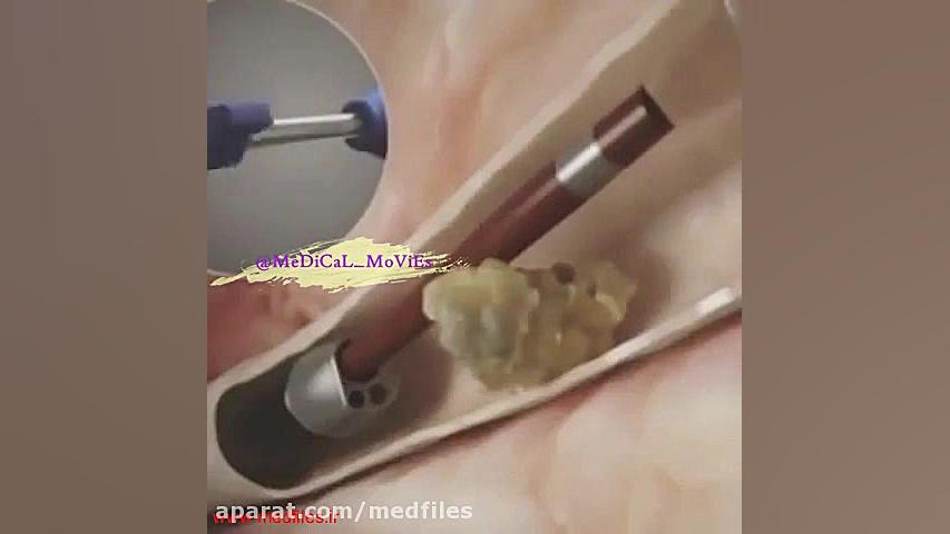 کلیپ نحوه خارج کردن سنگ حالب (TUL) و کلیه (PCNL) لیفت صورت
