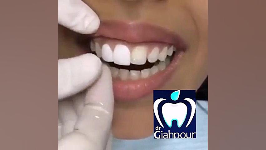لمینت دندان در کلینیک دنتال ایرانیان بیماری اپیدرمولیز بولوزا