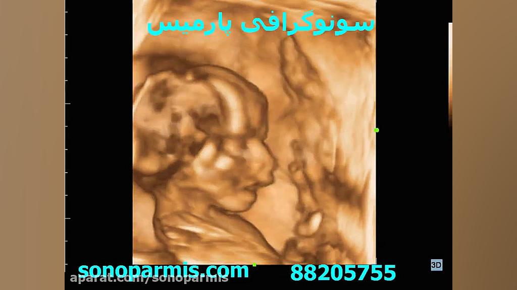سونوگرافی سه بعدی جنین لیزر فرکشنال