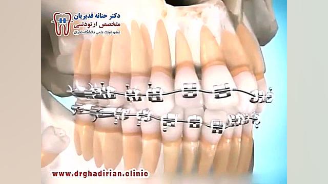 لزوم بررسى وضعیت دندانهاى عقل نهفته دکتر حنانه قدیریان