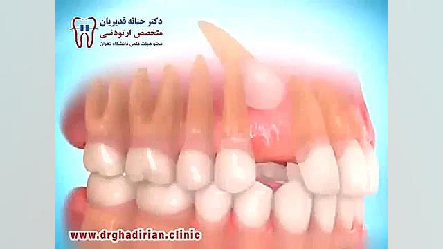 درمان ارتودنسى جهت دندان نیش نهفته دکتر حنانه قدیریان