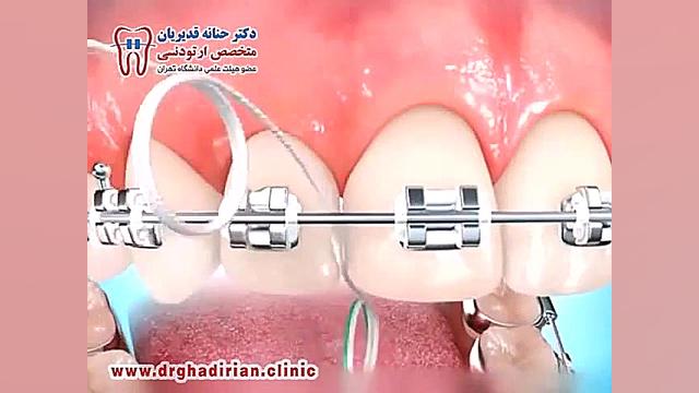 طریقه استفاده از نخ دندان در حین درمان ارتودنسى دکتر حنانه قدیریان