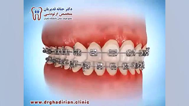 طریقه استفاده از مسواك بین دندانى در حین درمان ارتودنسی بیماری منیر