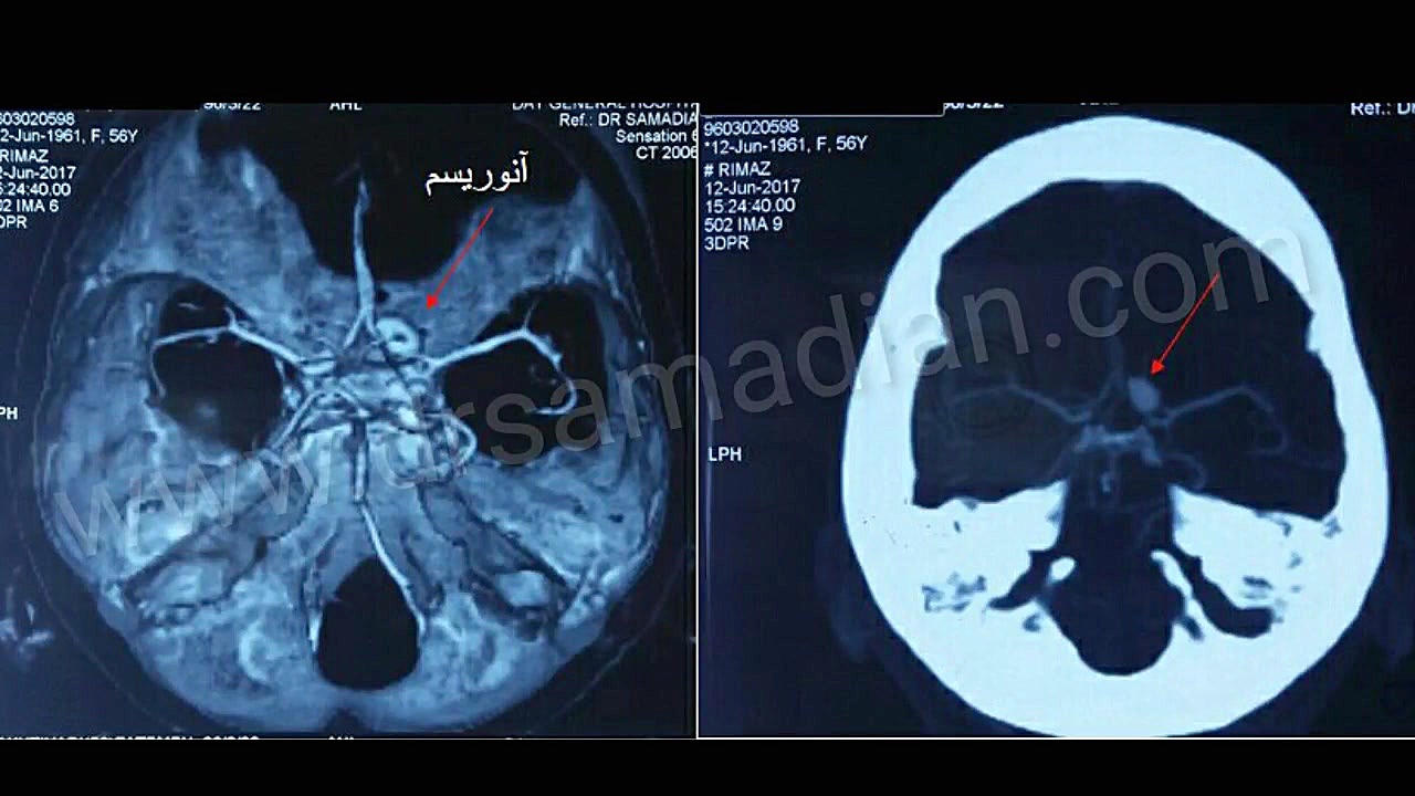 عمل جراحی کلیپ آنوریسم به صورت میکروسکوپی برداشتن زگیل