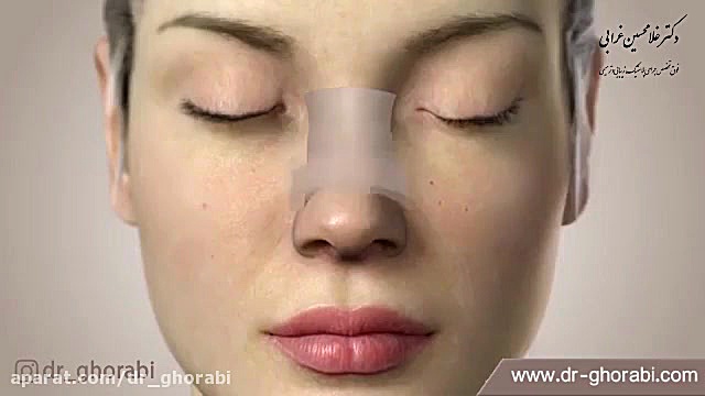 عمل جراحی بسته بینی دکتر غلامحسین غرابی