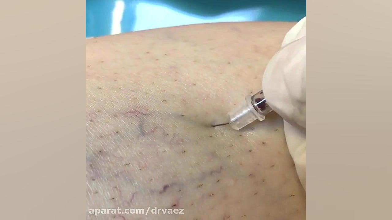 اسکلروتراپی برای درمان واریس توسط دکتر واعظ شوشتری دکتر علیرضا واعظ شوشتری