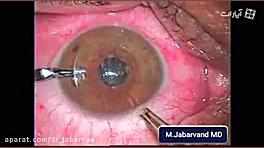 AICI implantation Keratoconus دکتر محمود جباروند بهروز