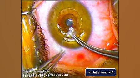 myoring implantation in Keratoconus دکتر محمود جباروند بهروز