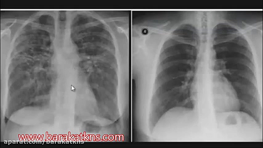 بیماری بینابینی ریوی، فیبر ریوی پزشکی میکروRNA