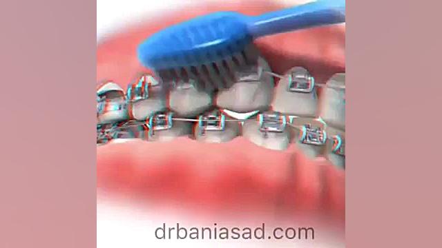 نحوه صحیح مسواک زدن با ارتودنسی دکتر نیما بنی اسد - متخصص ارتودنسی در تهران