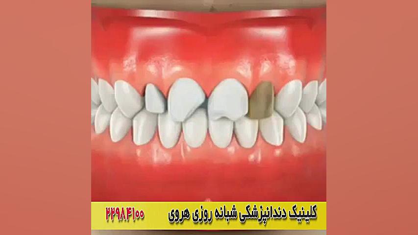 ترمیم دندان آسیب دیده و شکسته با لمینت دندان هایپرپاراتیروئیدیسم