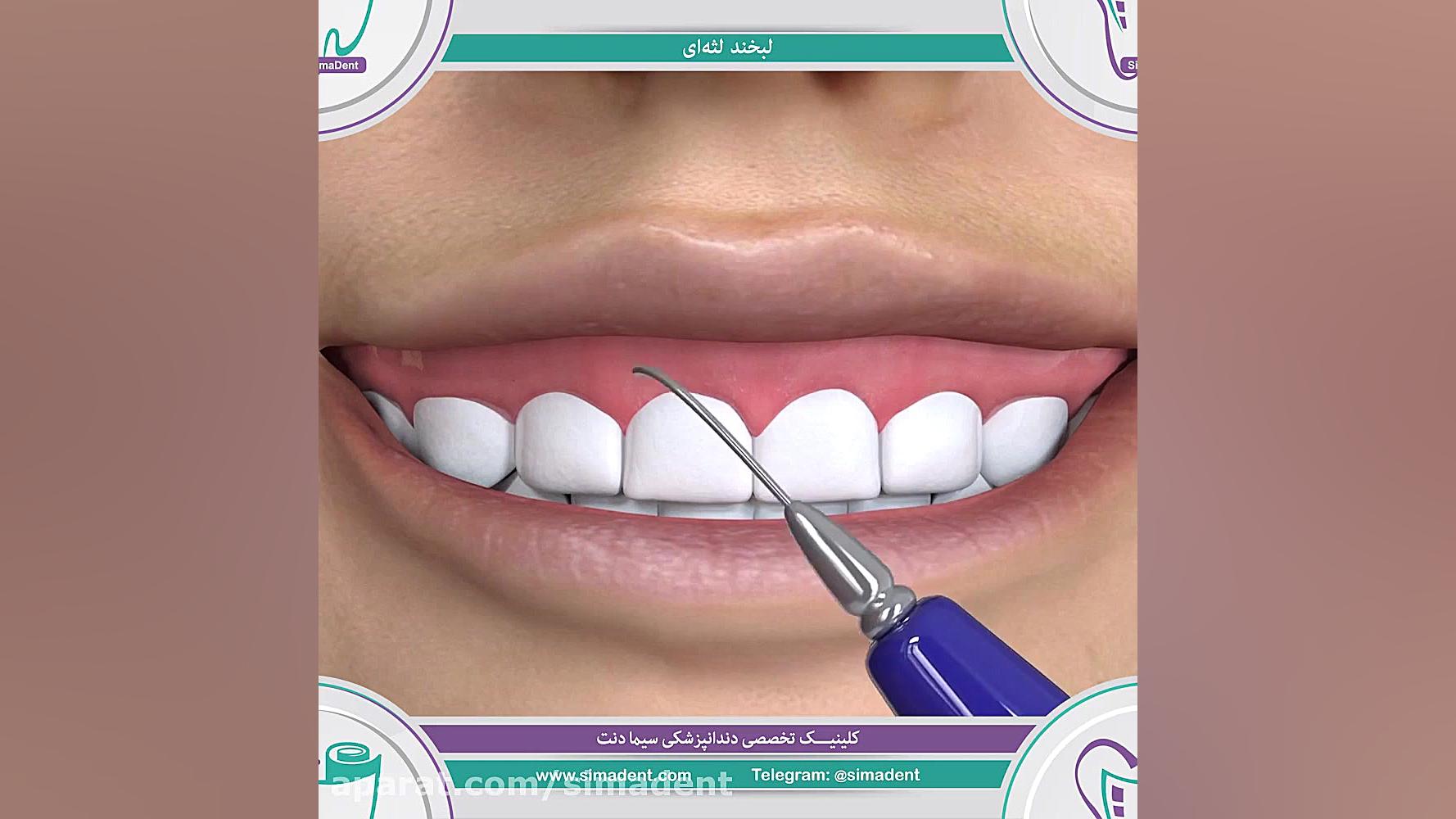 لبخند لثه ای | دندانپزشکی سیمادنت کاردیومگالی
