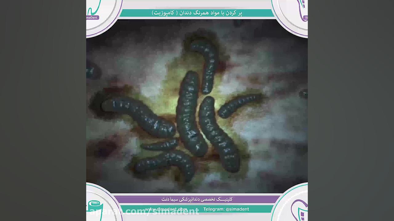 پرکردن دندان با مواد همرنگ دندان (کامپوزیت)| سیمادنت پلی‌داکتیلی