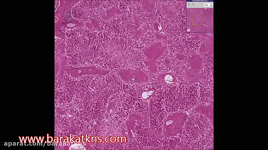 هیستوپلاسموز کبد زلاتان ابراهیموویچ