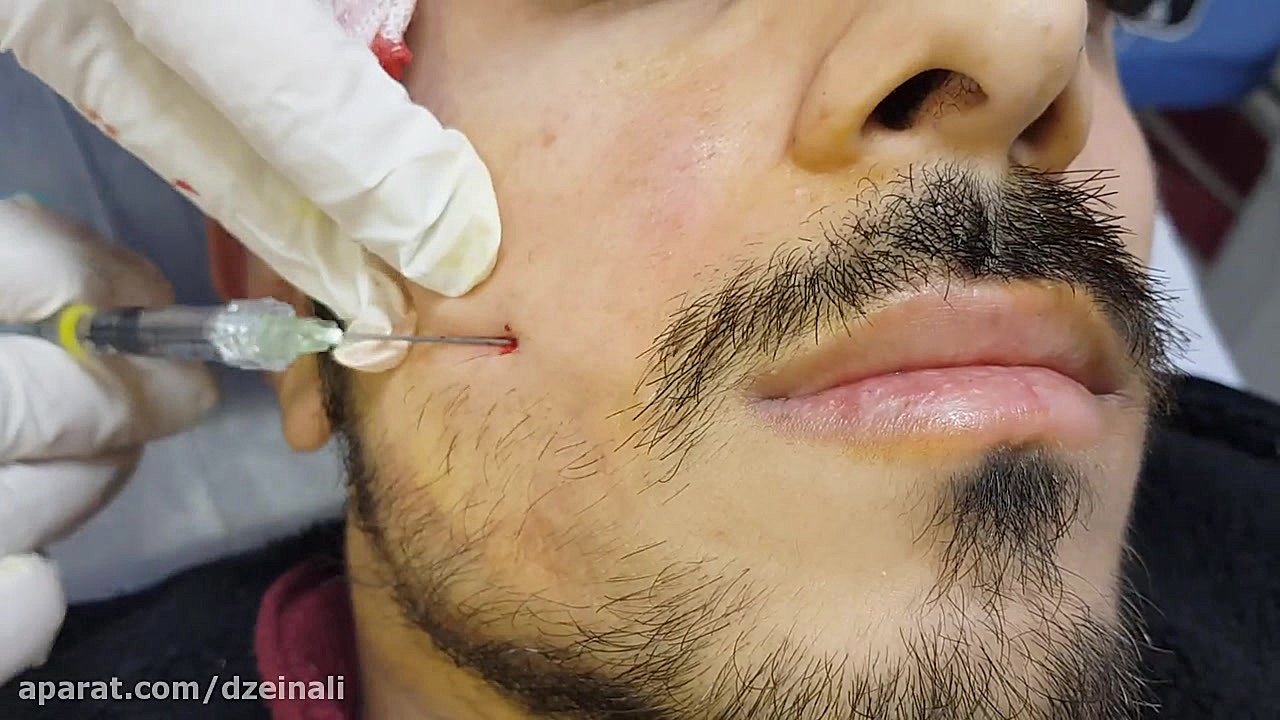 تزریق فیلر برای رفع لاغری صورت با روش کانولا دکتر فرحناز زینعلی - متخصص پوست، مو، زیبایی زنجان