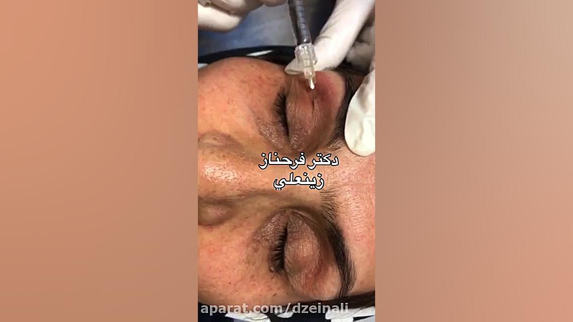 تزریق فیلر بلتروبالانس برای رفع گودی چشم دکتر فرحناز زینعلی - متخصص پوست، مو، زیبایی زنجان