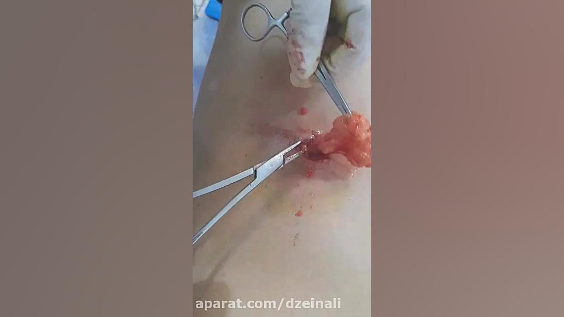 جراحی لیپوم بزرگ ناحیه پشت بیمار دکتر فرحناز زینعلی - متخصص پوست، مو، زیبایی زنجان