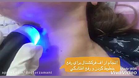 ویدیو کوتاهی از انجام آراف فرکشنال برای رفع خطوط گردن ژنراتور پالس عصبی
