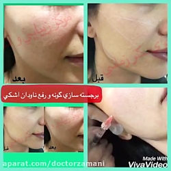 رفع ناودان اشکی و برجسته سازی گونه