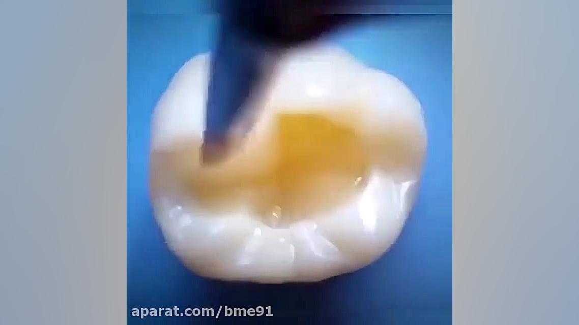 نحوه پر کردن دندان عصب کشی شده پلاستیک لثه