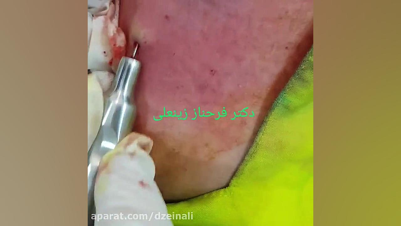 سابسیژن برای رفع اسکارهای فرورفته آکنه ( جوش صورت) دکتر فرحناز زینعلی - متخصص پوست، مو، زیبایی زنجان