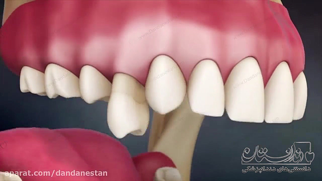 انیمیشن دندانپزشکی پوسیدگی دندان | دندانستان لنز تماسی دارورسان