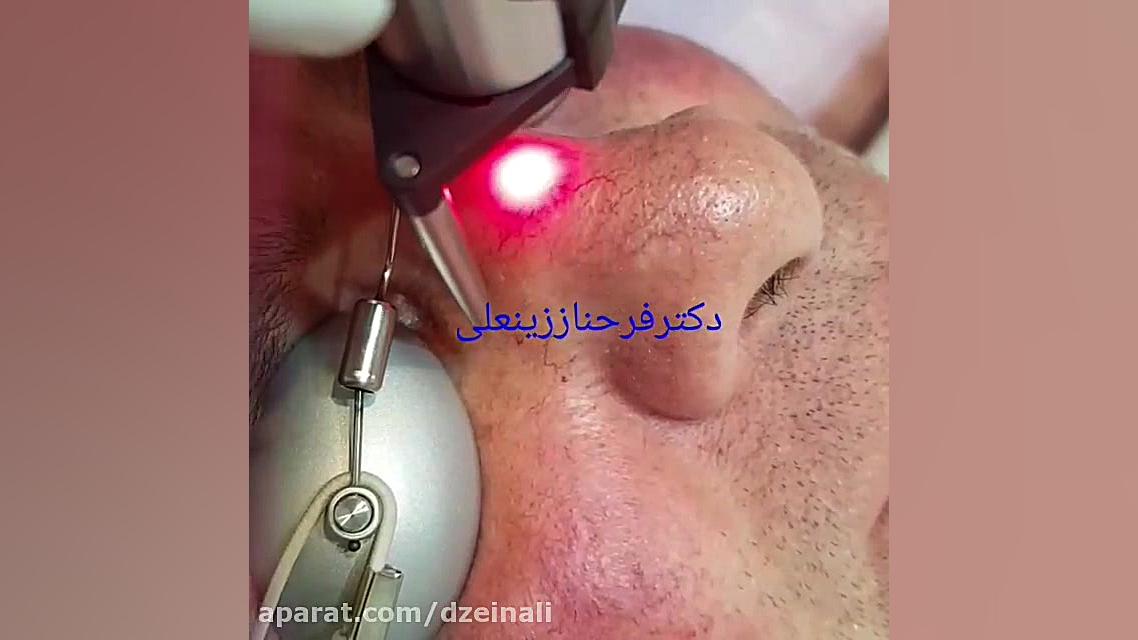 رفع دائمی واریس وتلانژکتازی و ضایعات عروقی دکتر فرحناز زینعلی - متخصص پوست، مو، زیبایی زنجان