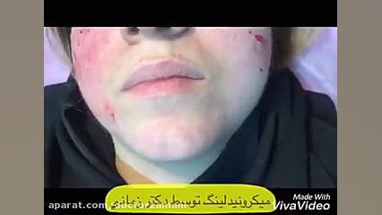 انجام میکرونیدلینگ و مزوتراپی پلاسماجت