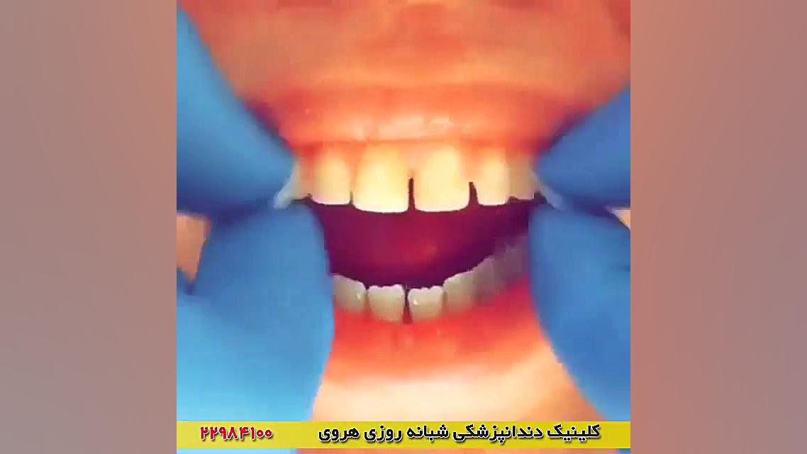 لمینت دندان - دندانپزشکی زیبایی هیدروپس فتالیس
