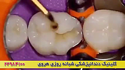 پرکردن دندان با مواد همرنگ دندان CUT&RUN