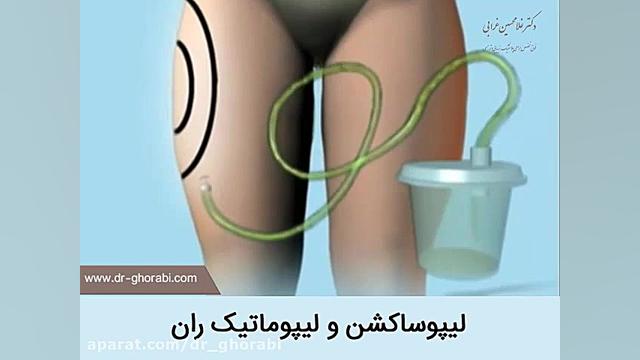 لیپوساکشن و لیپوماتیک ران توپوتیکان