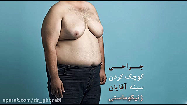 جراحی کوچک کردن سینه آقایان (ژنیکوماستی) دکتر غلامحسین غرابی