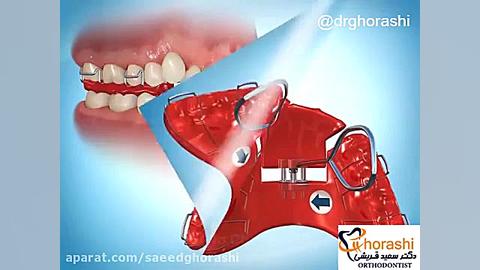 پلاک تصیح کننده وضعیت فک-دکتر سعید قریشی دکتر سعید قریشی