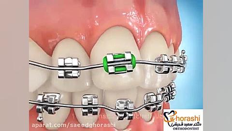 اورینگ ها در ارتودنسی-دکتر سعید قریشی دکتر سعید قریشی