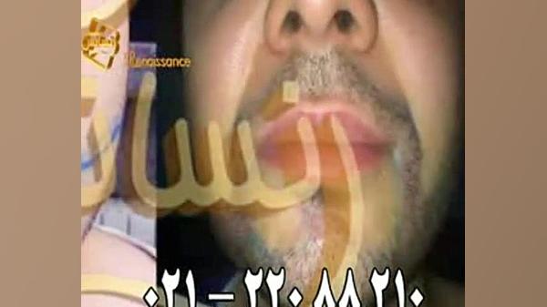 فیلم کاشت ریش و سبیل - کاشت مو و ترمیم مو رنسانس پلاستیک لثه