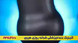 پر کردن دندان بعد عصب کشی کاتاپلکسی